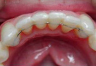 Ozarks-Orthodontics-Bonded-Retainer